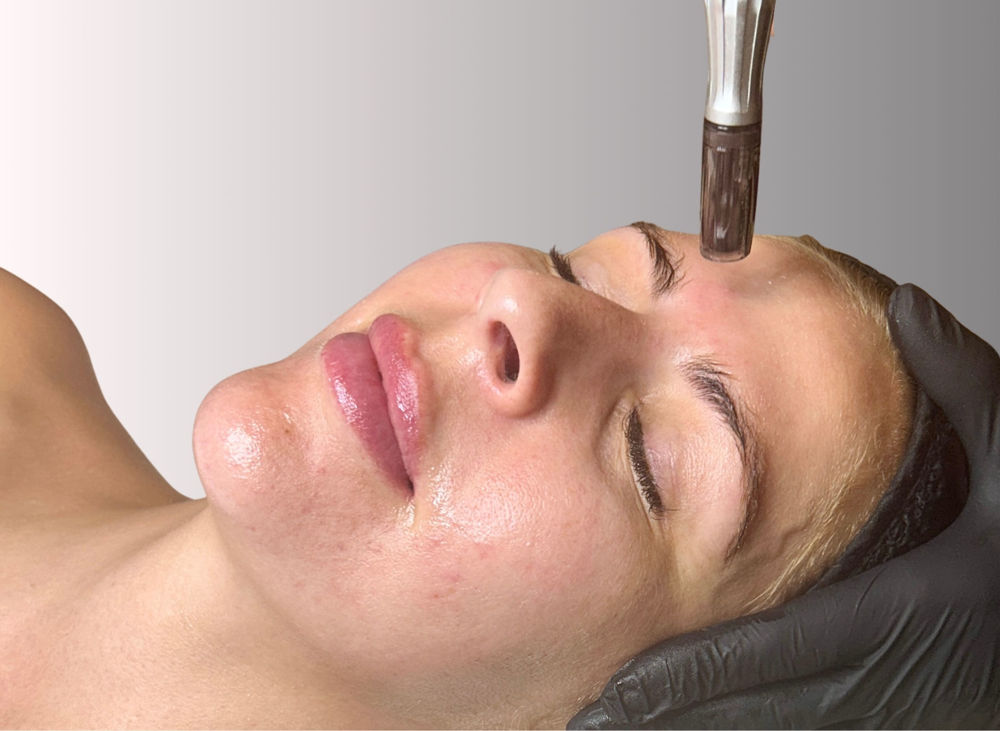 exo-booster-pro-peel-microneedling-topclinic